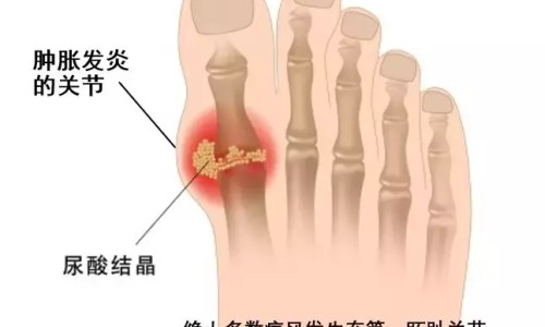 骨折病人吃什么好得快-骨折病人早上吃什么好网-分享骨折病人吃什么最好，骨折病人吃什么营养品好得快知识库